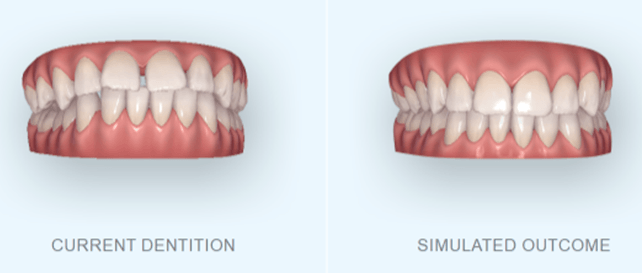 smile simulation