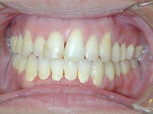 before and after dental photos